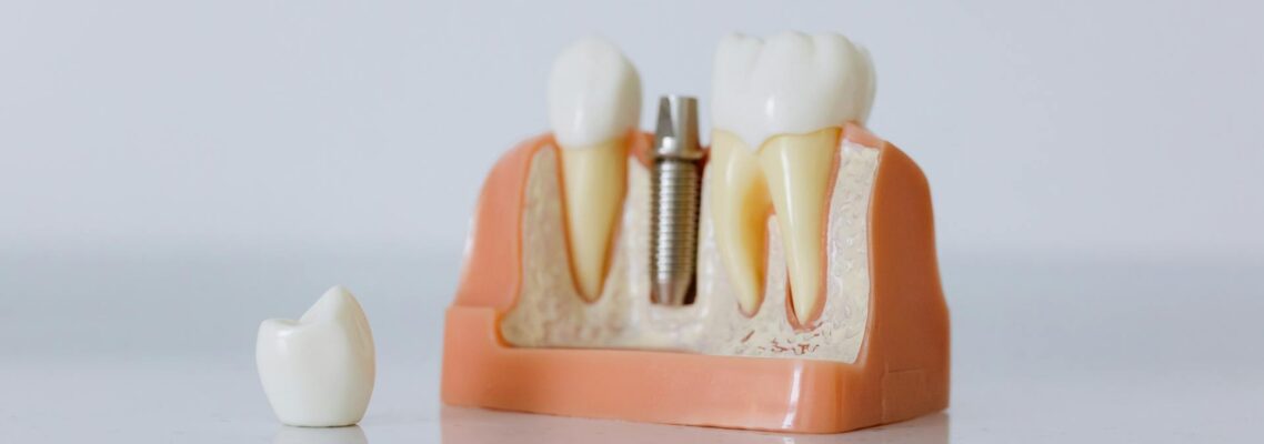 dental implants